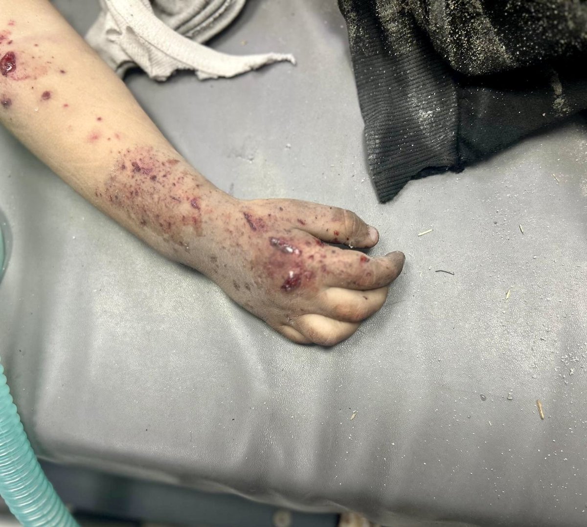 mikelayestaran's tweet image. MANOS DE GAZA cumple una semana en instagram.com/mikelayestaran y nos acerca historias de #Gaza del doctor español Raúl Incertis través de las manos de las víctimas. ¡SON NIÑOS!