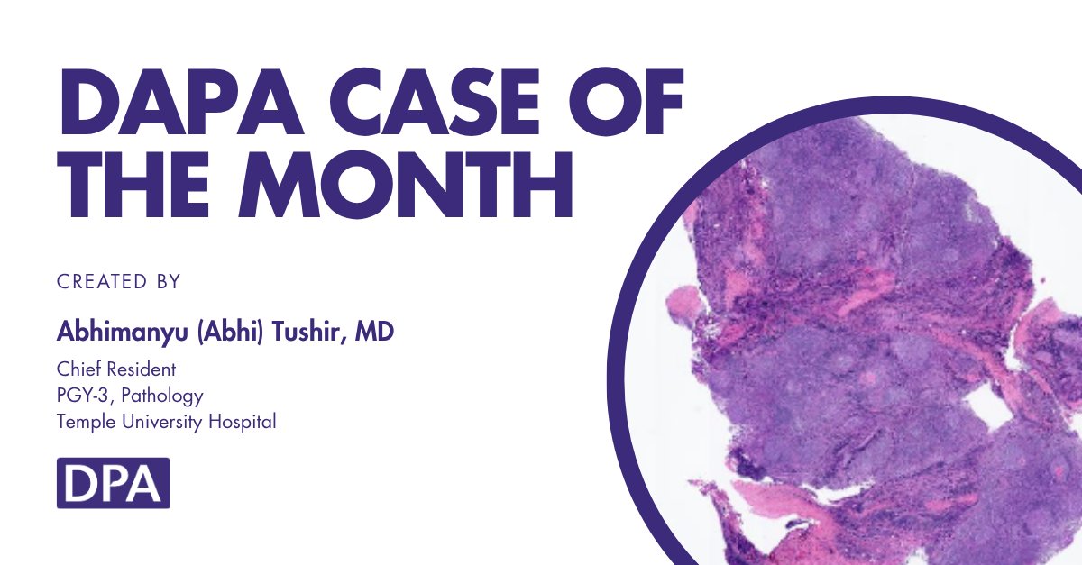 dpatweet's tweet image. A 65-year-old woman presents with generalized lymphadenopathy and night sweats. Biopsy reveals CD20+, CD10+, BCL6+, BCL2+ follicles with a Ki-67 of ~30%. FISH confirms t(14;18), IGH-BCL2 fusion.
Contributed by: Abhimanyu Tushir, MD
Take the assessment: zurl.co/5P7rZ