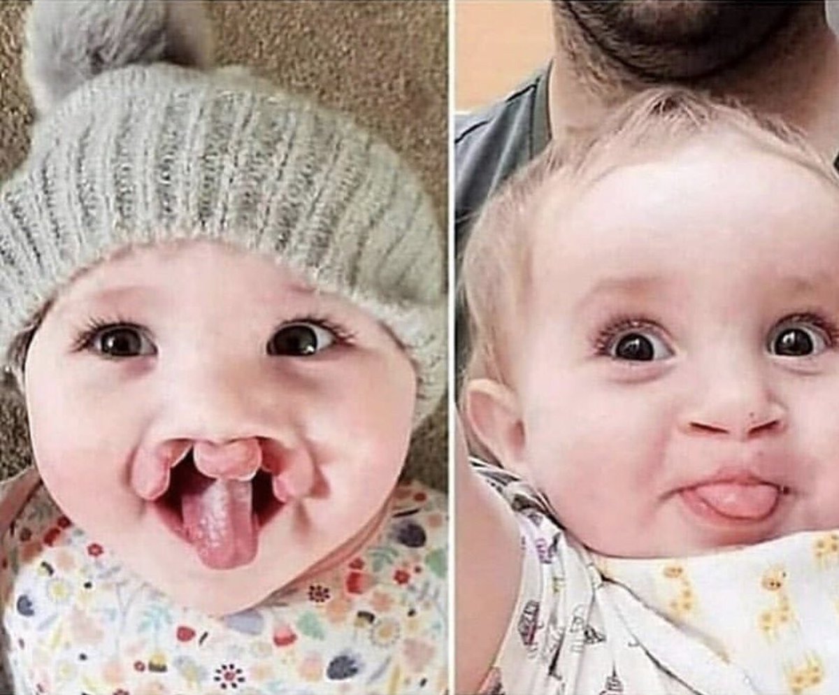 İşte tıp sanatı: 
Ameliyat öncesi ve sonrası 🥼🖼 👼