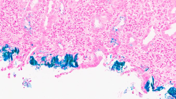 MhPathology's tweet image. 💡We found the culprit causing acute gastric pain.
🌟Iron pill gastritis
- Therapeutic iron pills/tablets induces &amp;amp; exacerbates erosive mucosal injury.
- H &amp;amp; E shows areas of mucosal ulceration &amp;amp; extracellular crystalline iron particle deposition (Iron stain highlights it)
#cwru