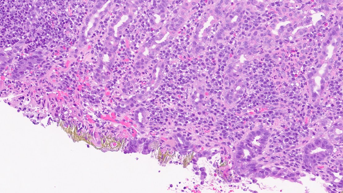 MhPathology's tweet image. 💡We found the culprit causing acute gastric pain.
🌟Iron pill gastritis
- Therapeutic iron pills/tablets induces &amp;amp; exacerbates erosive mucosal injury.
- H &amp;amp; E shows areas of mucosal ulceration &amp;amp; extracellular crystalline iron particle deposition (Iron stain highlights it)
#cwru