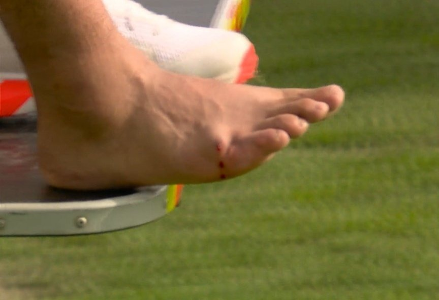 Rishabh Pant is retired hurt.  Swelling which is visible on the Right foot. 

#RishabhPant #INDvsENGTest