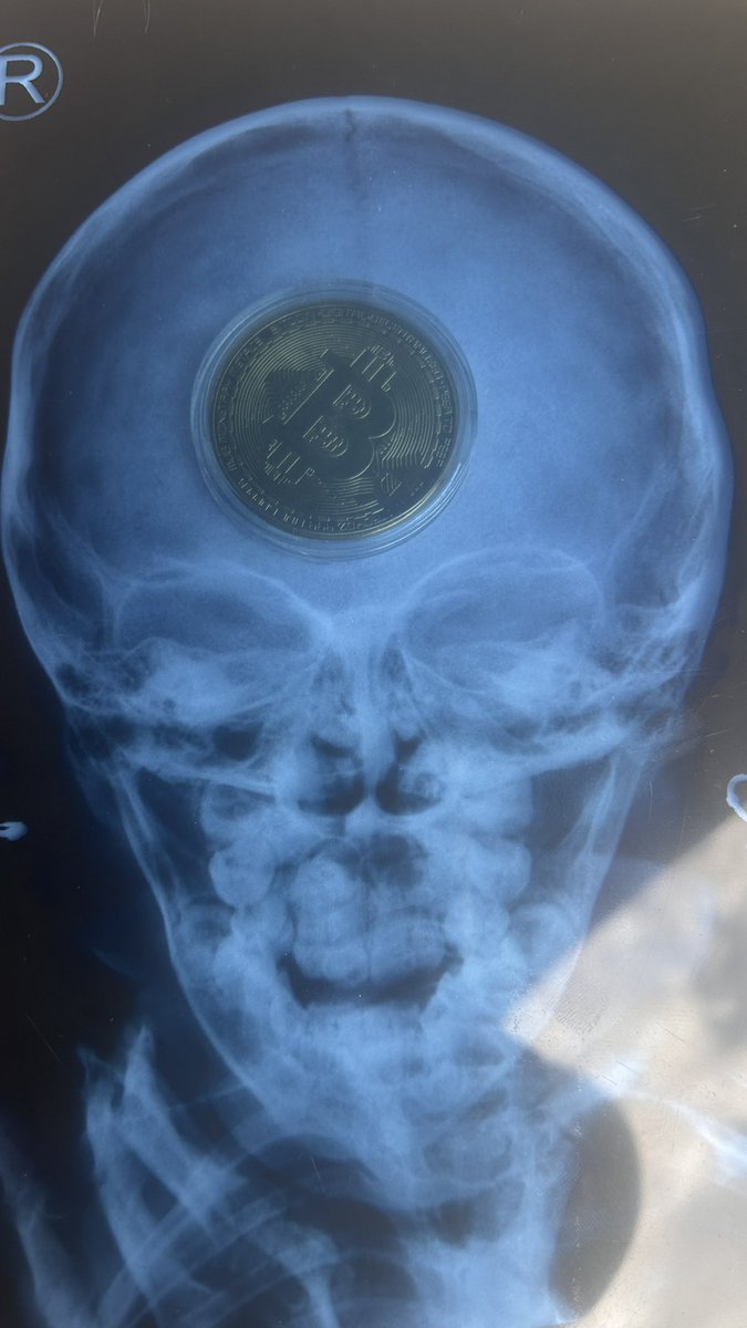 bitcoinr3's tweet image. Hoy fuimos a realizarnos una ecografía.
Acá el reporte de mi 🧑🦲 cabeza
