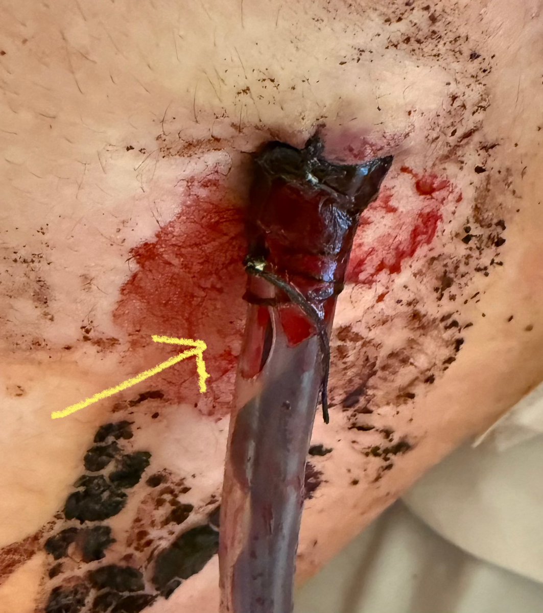 rbarbosa91's tweet photo. It is time to remove a chest tube and after you take the dressing down,  the side hole is out (yellow arrow). Air is going into and out of the side hole with each breath.

Is there a way to salvage the situation, without putting another chest tube in? 

(Hint: yes - answer later) https://t.co/ECXGyWBJCx