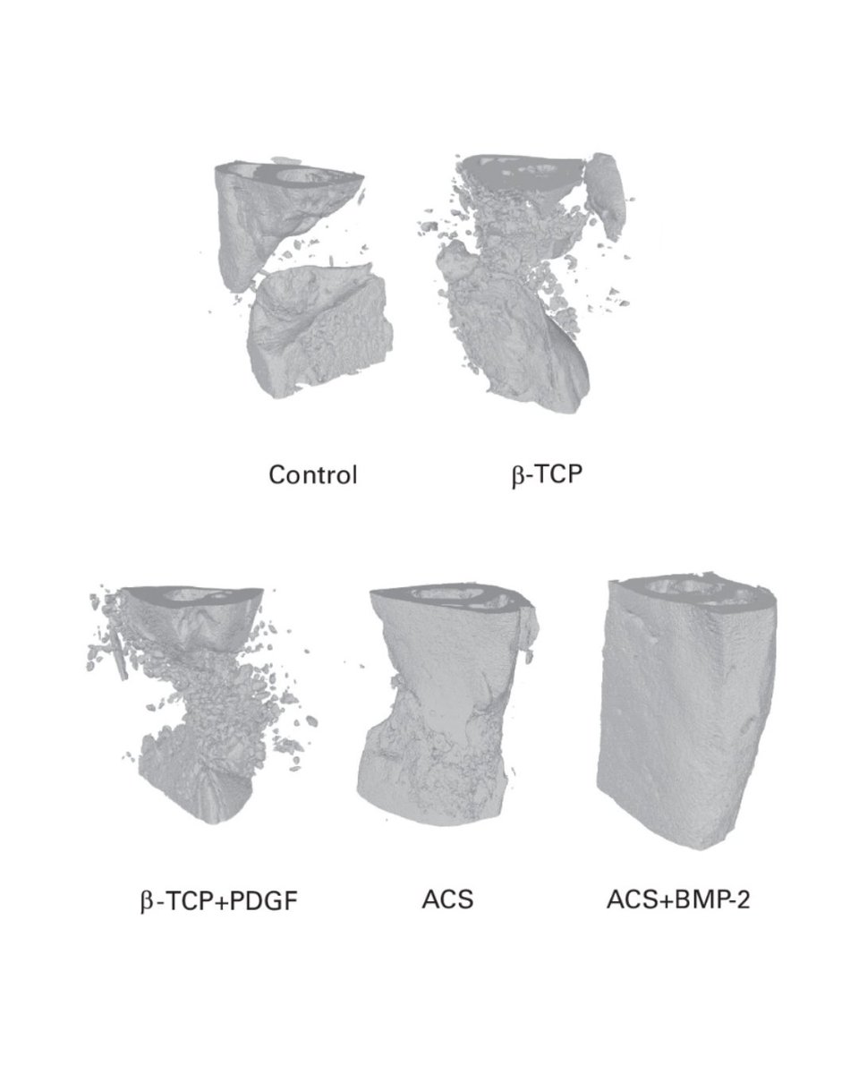 BoneJointJ's tweet image. Among the commercially available growth factors, bone morphogenetic protein-2 treatment may be superior to platelet-derived growth factor treatment for the management of nonunion and bone defects.
#Bone #GrowthFactor #Orthopedics #BJJ
ow.ly/yG4G50Wki70