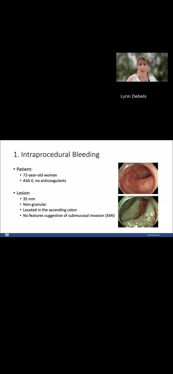 🚨 The ESGE “Wednesday Webinar” has just kicked off!
🧠 Endoscopy 101: How to Steer Clear of Mistakes is live now — and it’s not too late to tune in for an engaging, case-based session with practical insights for all early career #GIEndoscopy professionals
tinyurl.com/3wx8u4uf