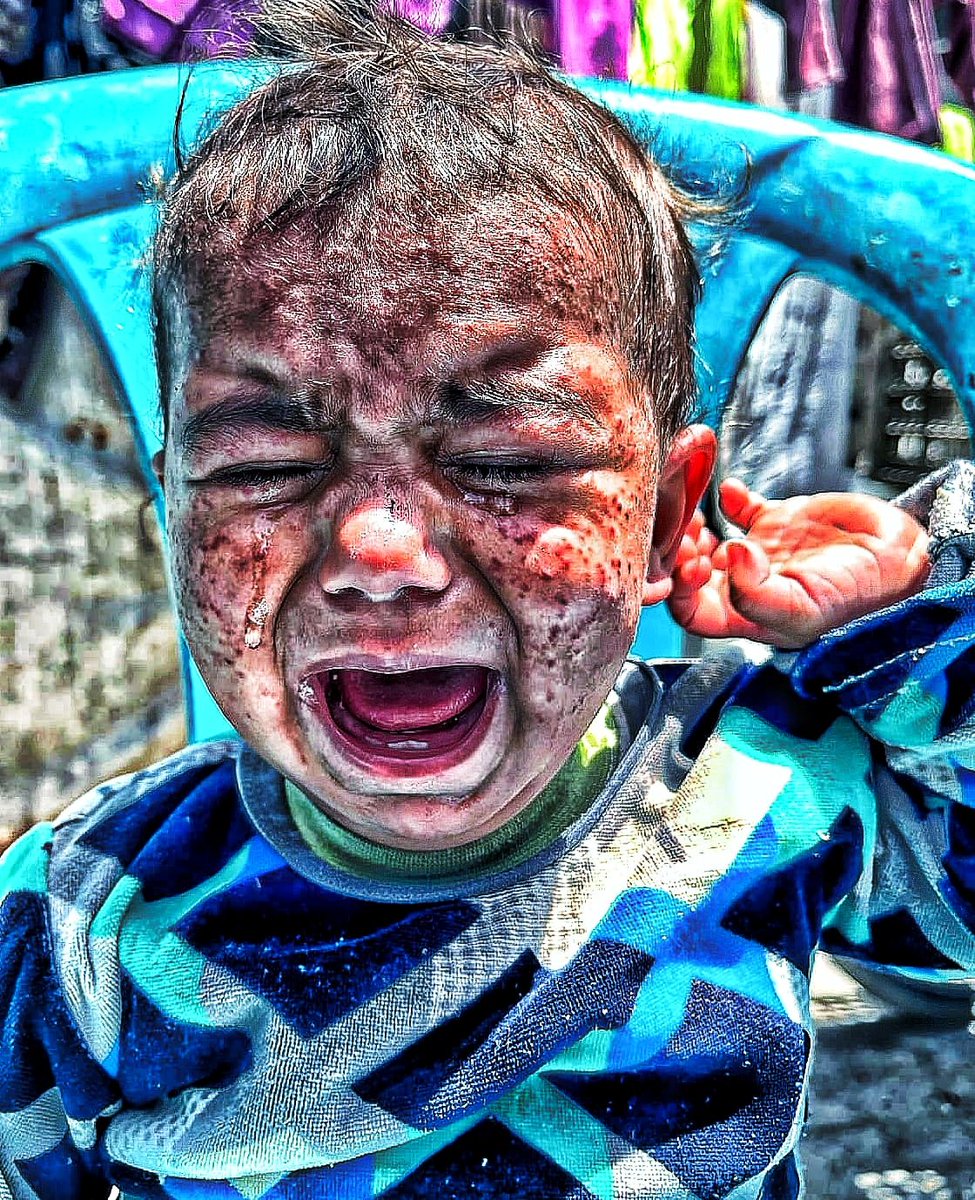 AhmadDGaza's tweet image. Save childhood, people 馃槬 Joud is feeling severe burning and pain, and her health is getting worse than before. Jude needs you 馃挃 Be the reason for Jude's recovery. Do nate even a little. chuffed.org/project/139995