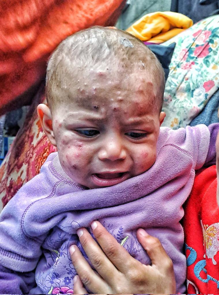 mahmoud60013's tweet image. Please, don't let her suffer any more. Tasneem can't even stop the tears from falling from her swollen eyes, which are ravaged by the skin disease. Blisters and pimples have spread across her thin body until they reach her eyes. Her tears burn and don't soothe, and the pain is…