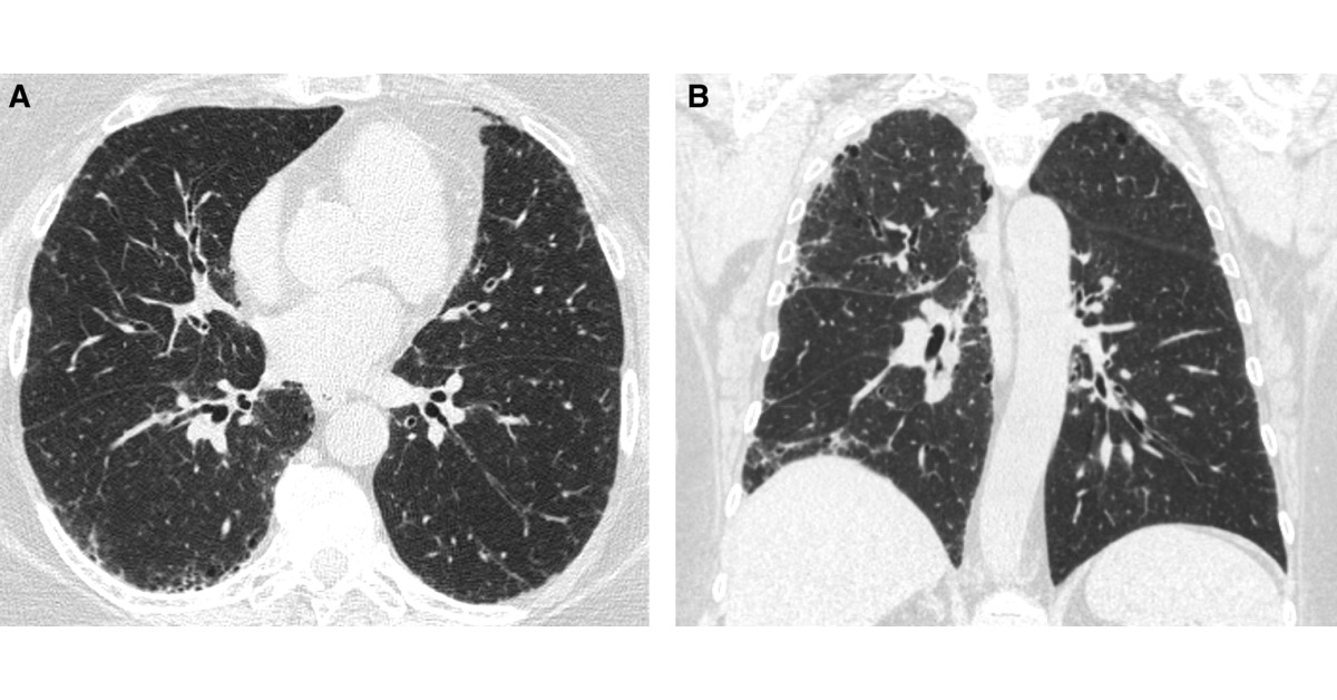 ATSBlueEditor's tweet image. Approach to the Evaluation and Management of Interstitial Lung Abnormalities: An Official American Thoracic Society Clinical Statement
@atscommunity 

🔓 Open Access

🔗 tinyurl.com/4vjm9zdw