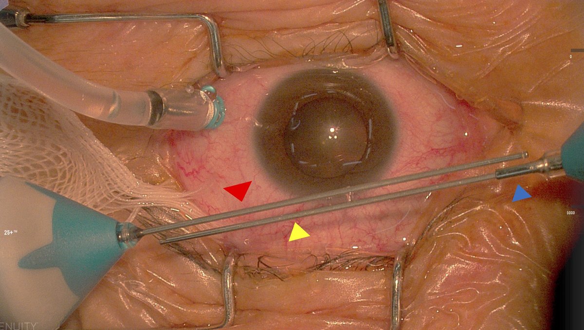 AAOjournal's tweet image. Long-shaft vitrectomy probe for vitreoretinal diseases in highly myopic eyes: a randomized controlled trial
ow.ly/3K5c50WcVEX
#ophthalmology #myopia