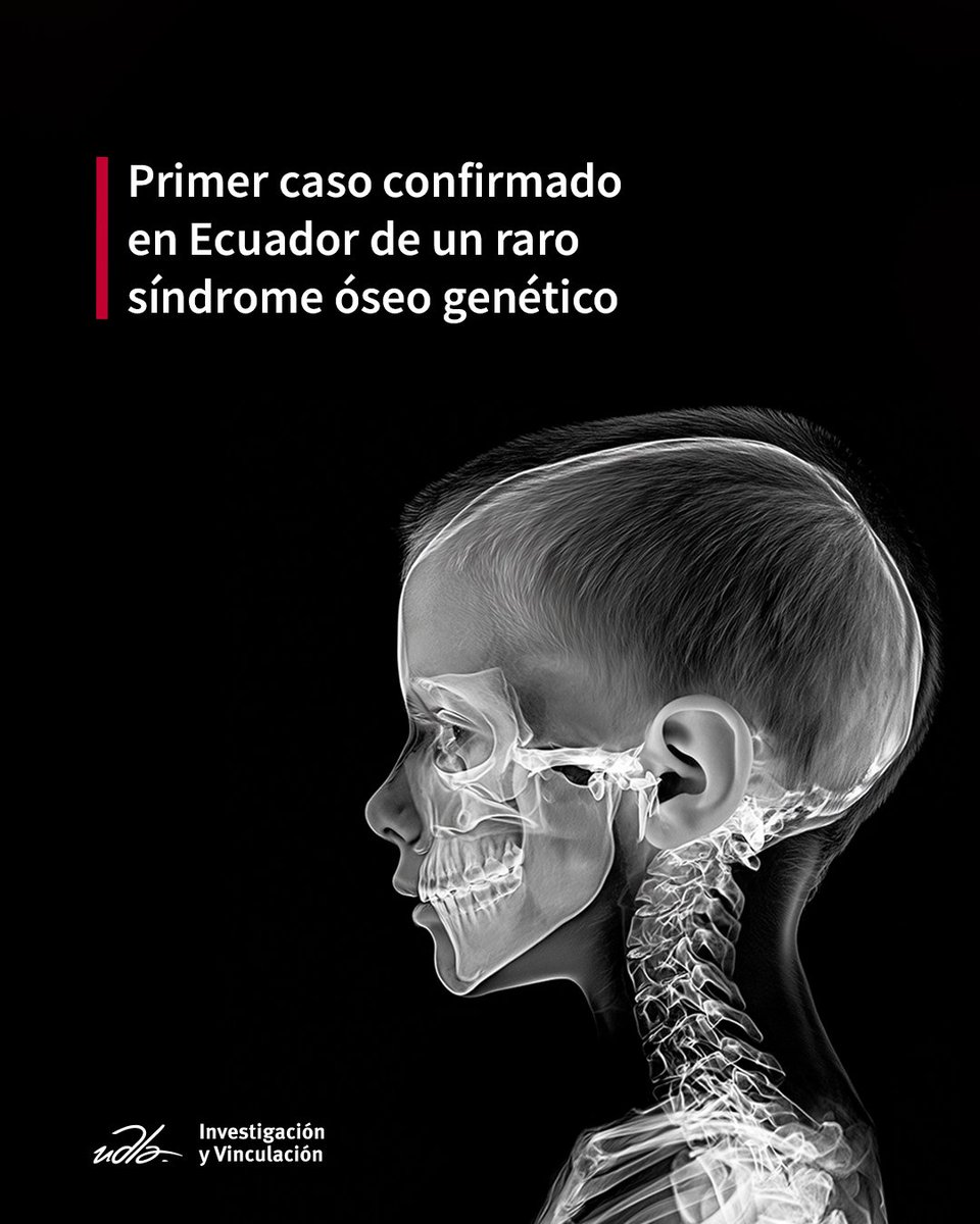 Investigación y Vinculación UDLA (@udla_investiga) on Twitter photo 🔬 Primer caso confirmado en 🇪🇨 del síndrome genético Dyggve–Melchior–Clausen fue publicado por el Dr. Alejandro Cabrera de la <a href="/UDLAEcuador/">UDLA Ecuador</a>. ¡Un hito para el diagnóstico genético en el país!
👉 mdpi.com/2073-4425/16/5…
#UDLAinvestiga #Genética #EnfermedadesRaras 🔬 Primer caso confirmado en 🇪🇨 del síndrome genético Dyggve–Melchior–Clausen fue publicado por el Dr. Alejandro Cabrera de la <a href="/UDLAEcuador/">UDLA Ecuador</a>. ¡Un hito para el diagnóstico genético en el país!
👉 mdpi.com/2073-4425/16/5…
#UDLAinvestiga #Genética #EnfermedadesRaras