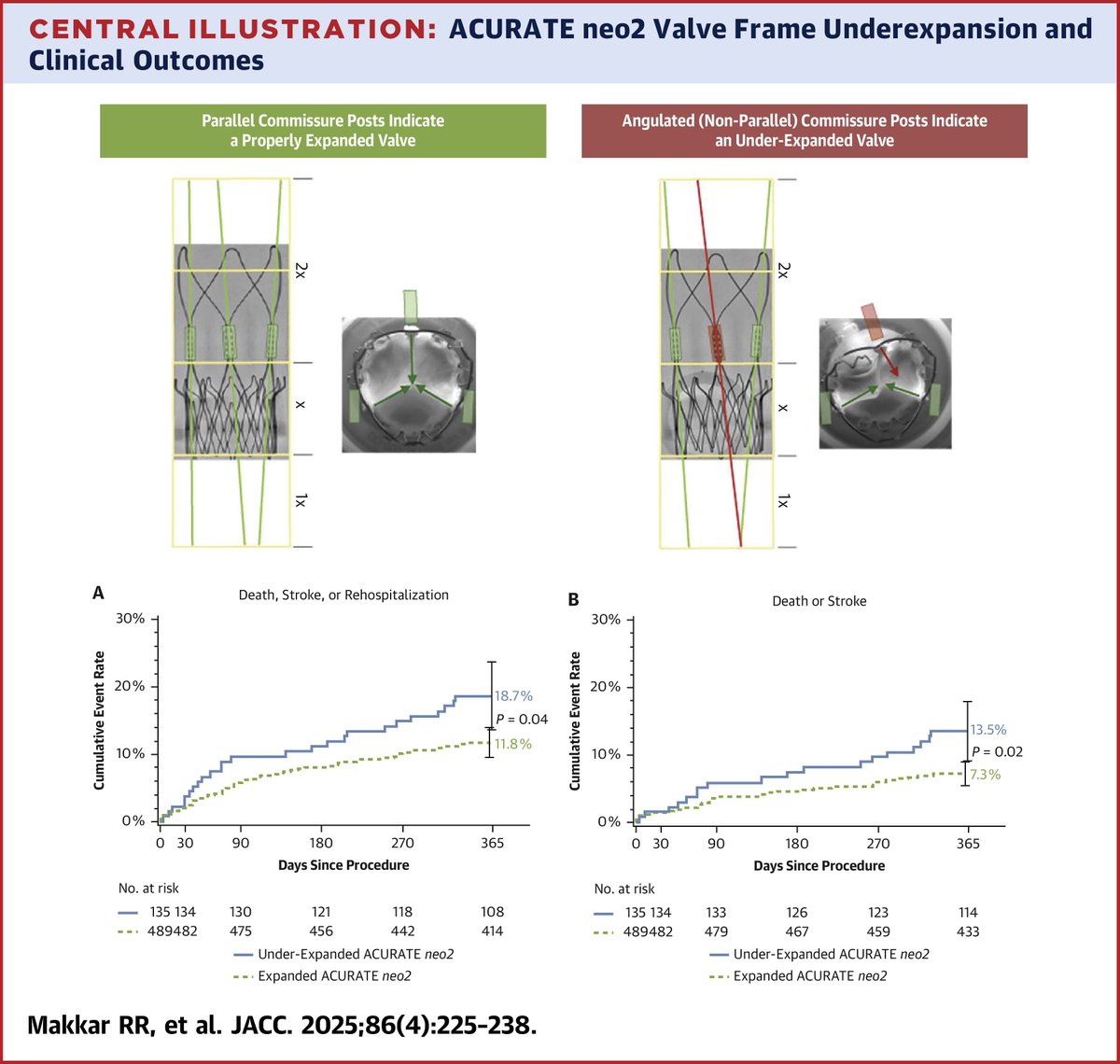 JACCJournals's tweet image. Underexpansion of the ACURATE neo2 valve in the ACURATE IDE study was assoc with a higher risk of the composite endpoint of death, #stroke, or rehospitalization. As a post hoc analysis, results should be viewed as hypothesis-generating jacc.org/doi/10.1016/j.…

#JACC #TAVR #vhdAS