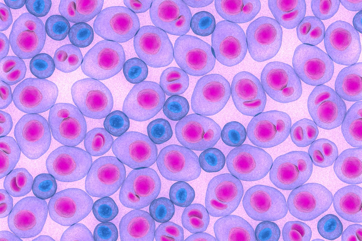 Blood Cancers Today (@blood_cancers) on Twitter photo Daratumumab outperforms active monitoring in patients with high-risk smoldering multiple #myeloma, according to a study led by <a href="/thanosdimop/">Thanos Dimopoulos</a>, of <a href="/uoaofficial/">University of Athens</a>, and published in <a href="/NEJM/">NEJM</a>.
📰 buff.ly/FwLBpoX Daratumumab outperforms active monitoring in patients with high-risk smoldering multiple #myeloma, according to a study led by <a href="/thanosdimop/">Thanos Dimopoulos</a>, of <a href="/uoaofficial/">University of Athens</a>, and published in <a href="/NEJM/">NEJM</a>.
📰 buff.ly/FwLBpoX