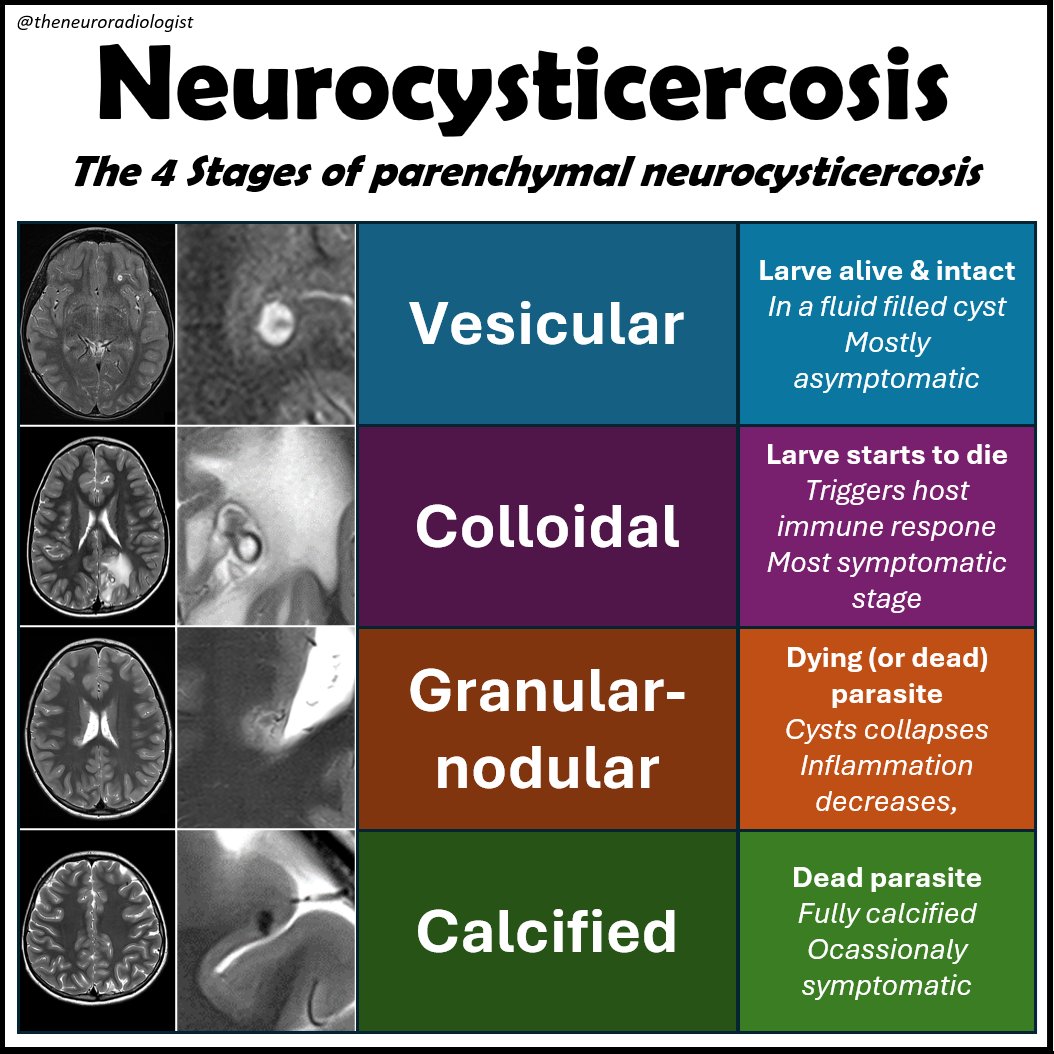 theneuroradguy's tweet image. New video on imaging findings in neurocysticercosis: youtube.com/watch?v=8ft_rr…

#MEDed #FOAMed #RADed #FOAMrad #radres #neurorad