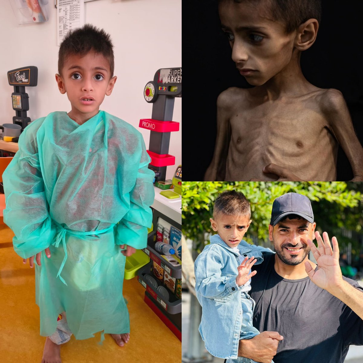 abdallahatar's tweet image. الطفل أسامة الرقب كان يعاني من سوء تغذية حاد، بينما حاول الاحتلال تضليل العالم بالقول إن حالته بسبب أمراض وراثية، وليس الجوع. اليوم، بعد نقله لإيطاليا، تحسنت صحته بشكل واضح، وهذا يؤكد أن السبب كان المجاعة، لا المرض.
شكر خاص للزميل الصحفي الإنسان سمير البوجي، الذي أوصل صوت وصورة…