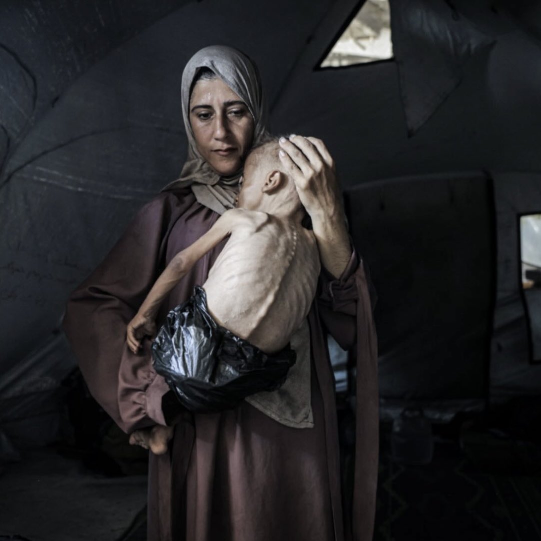 BenjAlvarez1's tweet image. Starvation in Gaza. A 1.5-year-old child faces life-threatening malnutrition in Gaza City as the humanitarian situation worsens due to ongoing Israeli attacks and blockade. Picture via Ahmed Jihad Ibrahim Al-arini/Anadolu/Getty Images.