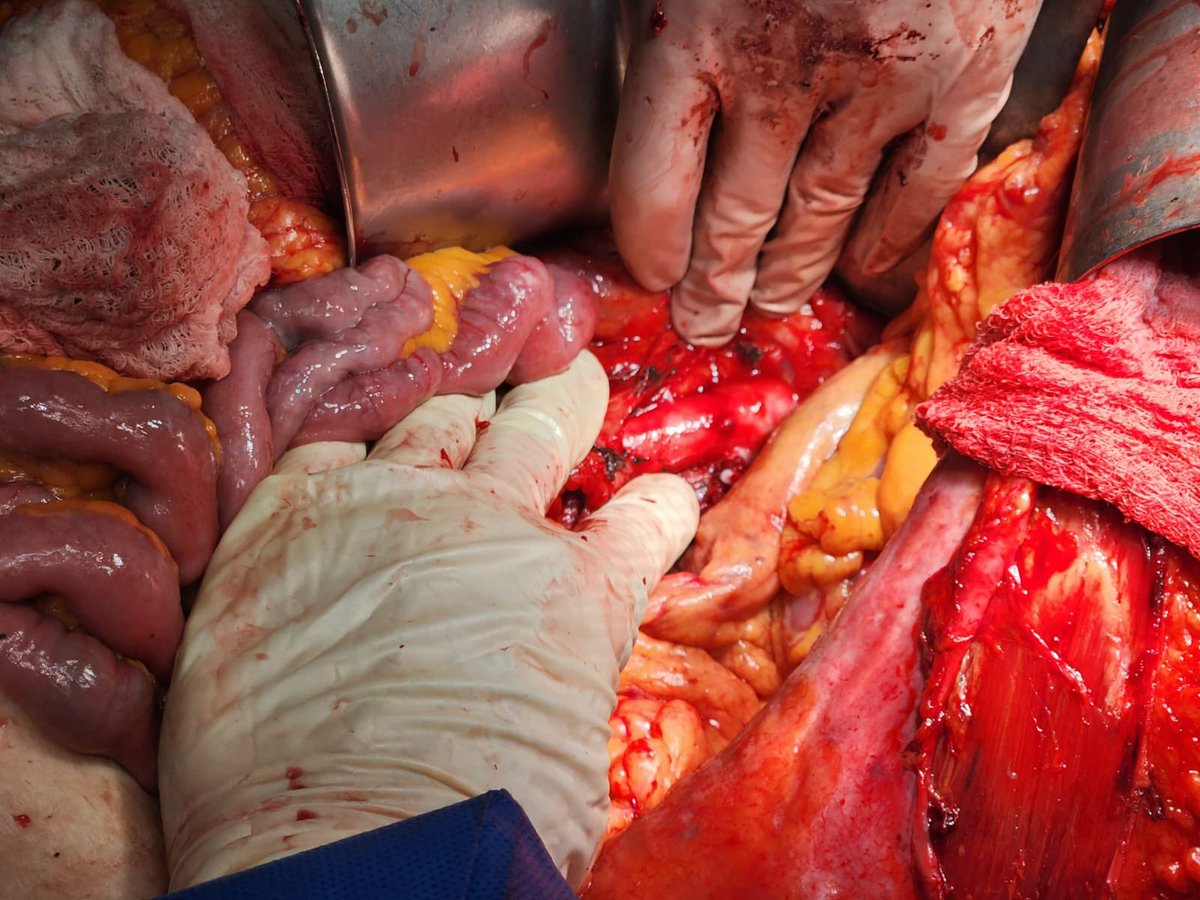 VicenteRojasUro's tweet photo. Sometimes the minimally invasive approach is not possible — that’s when open surgery still plays a key role. Today we performed a nephrectomy for a 20 cm renal tumor with a thrombus in the left renal vein. Surgery done with a great team! 
@TestaItzhak 

#nephrectomy #opensurgery https://t.co/jSX9id1KwZ