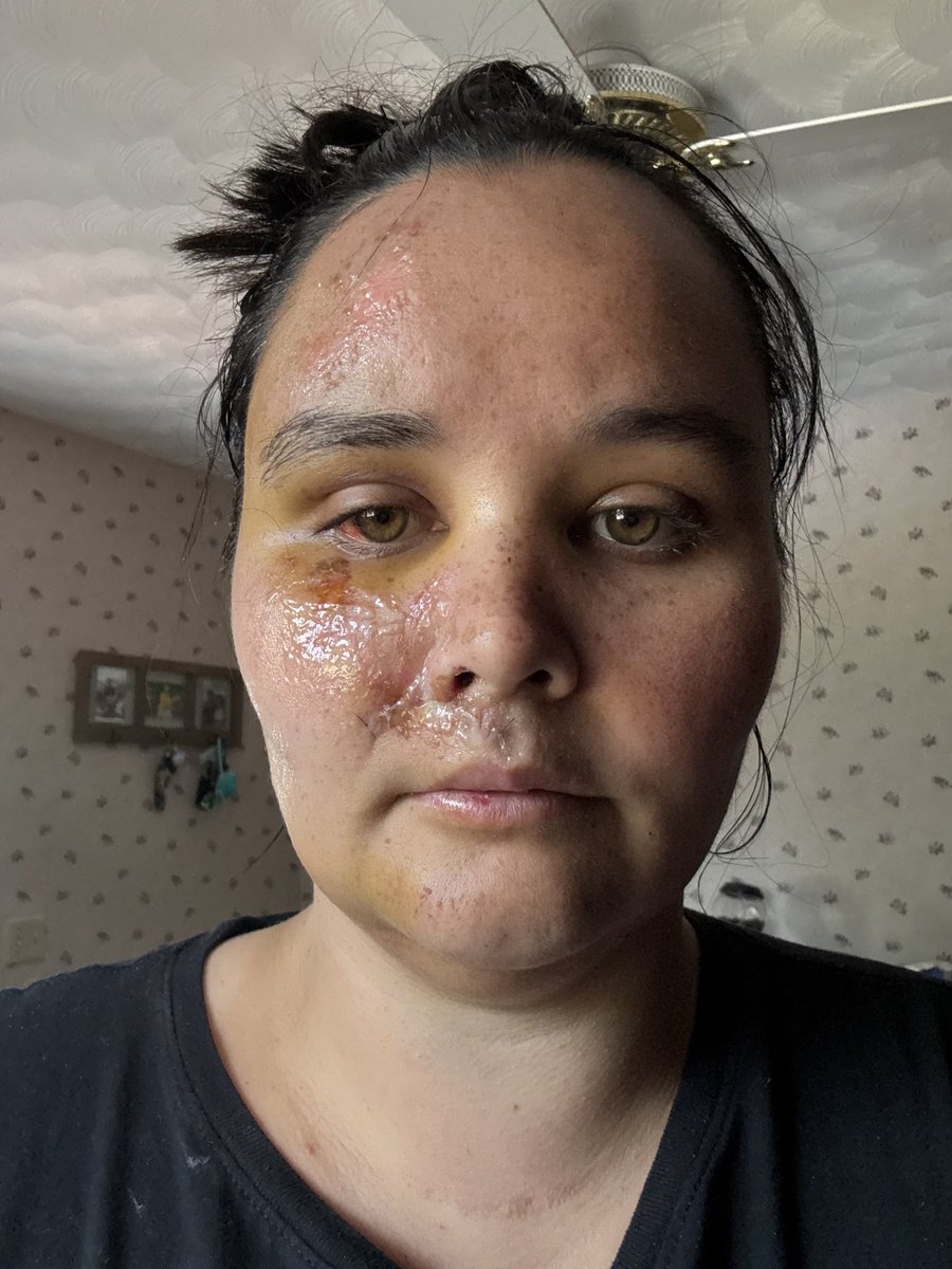 I’m so sad. My best friend was making the perfect SAW mask for me to have <a href="/ScottGPatterson/">Scott G. Patterson</a> sign this weekend and I got into an accident and can’t go 😭black eye, stitched in my face and mouth