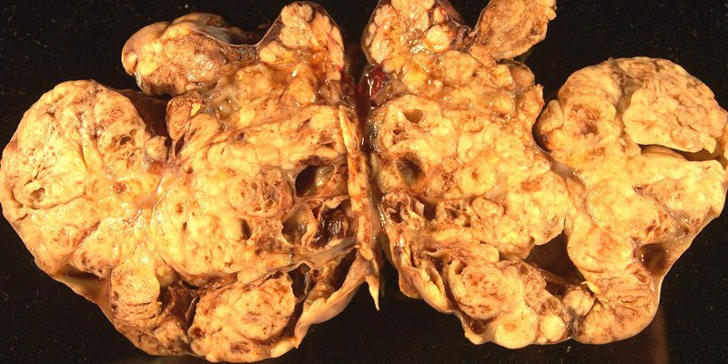 Relacorilant plus nab-paclitaxel improves survival in platinum-resistant ovarian cancer patients dlvr.it/TM4lXD #ChronicDisease #Oncology