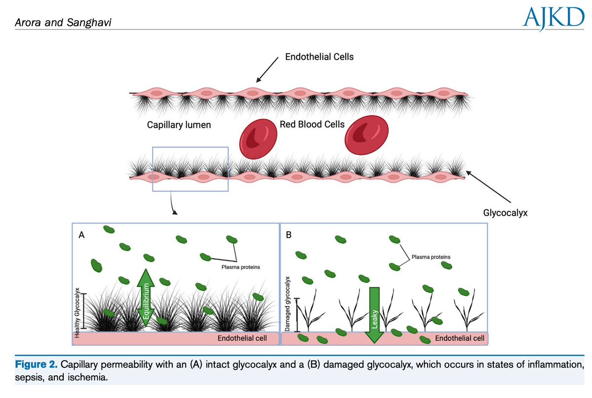 AJKDonline's tweet image. In this Core Curriculum, @captainchloride and Sarah Sanghavi discuss disorders of volume, which are typically identified clinically as changes in the extracellular space, and management strategies through a series of clinical vignettes: 

bit.ly/Arora24CC (FREE)