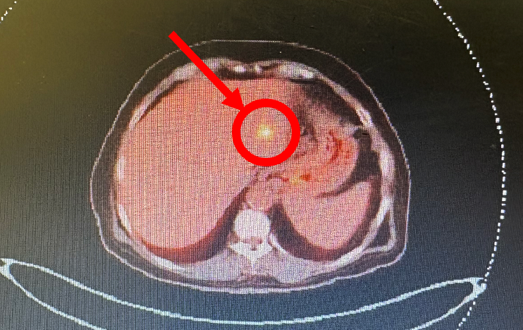 إجراء نوعي لمريض بسرطان القولون (المرحلة الرابعة)، تم استئصال القولون ➕ إعطاء العلاج الكيميائي البيني ➕ استئصال امتداد الورم في الكبد المكتشف عبر الأشعة البوزيترونية PET 🔬

قاد العملية د. سعيد خيار (استشاري جراحة الكبد) بعد نقاشها في المجلس العلمي للأورام بـ <a href="/sghaseer/">المستشفى السعودي اﻷلماني عسير</a> 👏✨