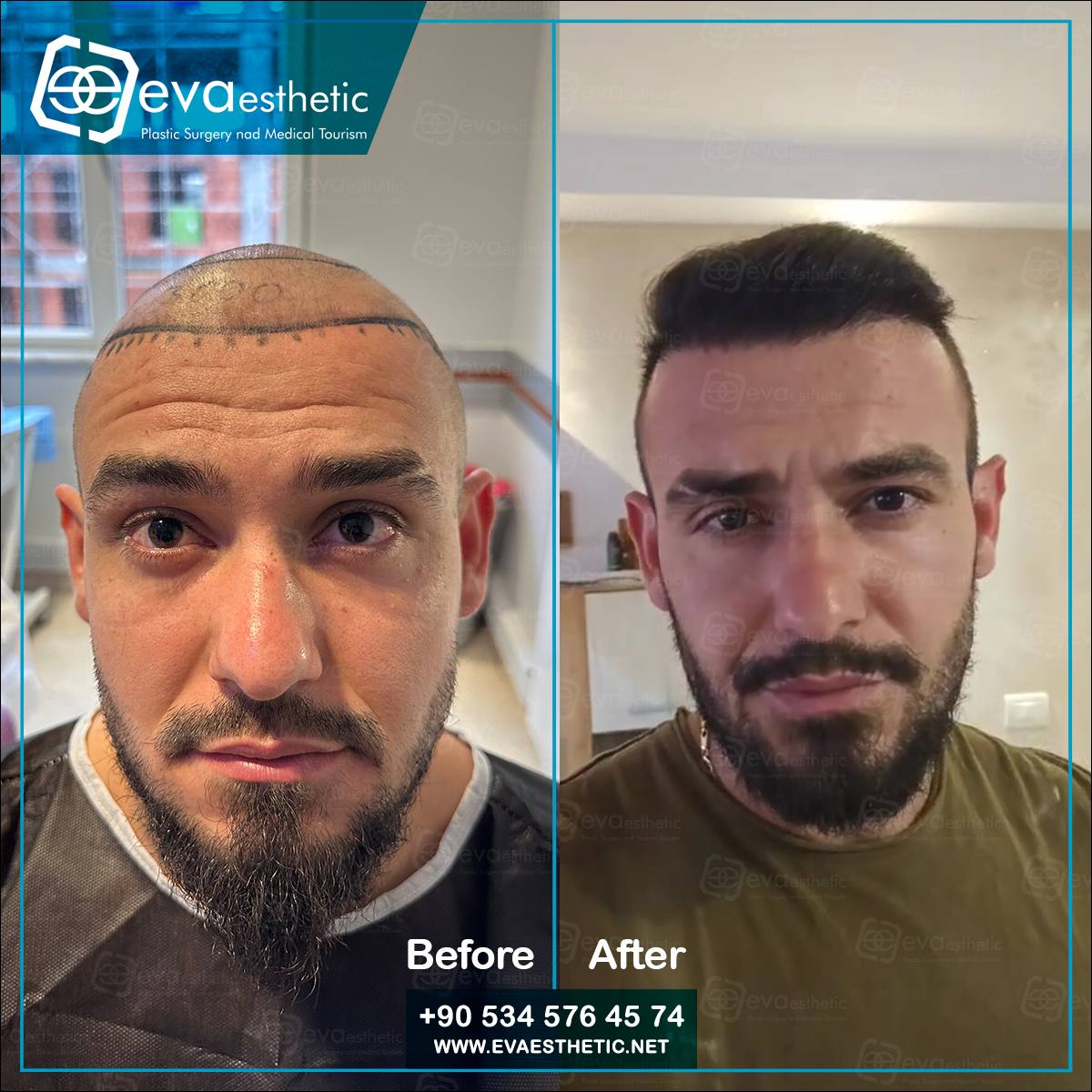evaesthetic's tweet photo. Eva Esthetic | #Hair_Transplant ✔️.

#Hairtransplantation in #Turkey #Istanbul
Eva esthetic The #bestHairTransplant Hospital In #Istanbul 🇹🇷
#HairTransplantturkey
#plasticsurgery 
#Eyebrow_Transplant #Beard_Transplant
 🔗👇
Book now via📲:WhatsApp;📲 +905345764574
🇺🇸🇬🇧🇪🇸🇫🇷🇷🇴 https://t.co/Mb9qJMUHzY