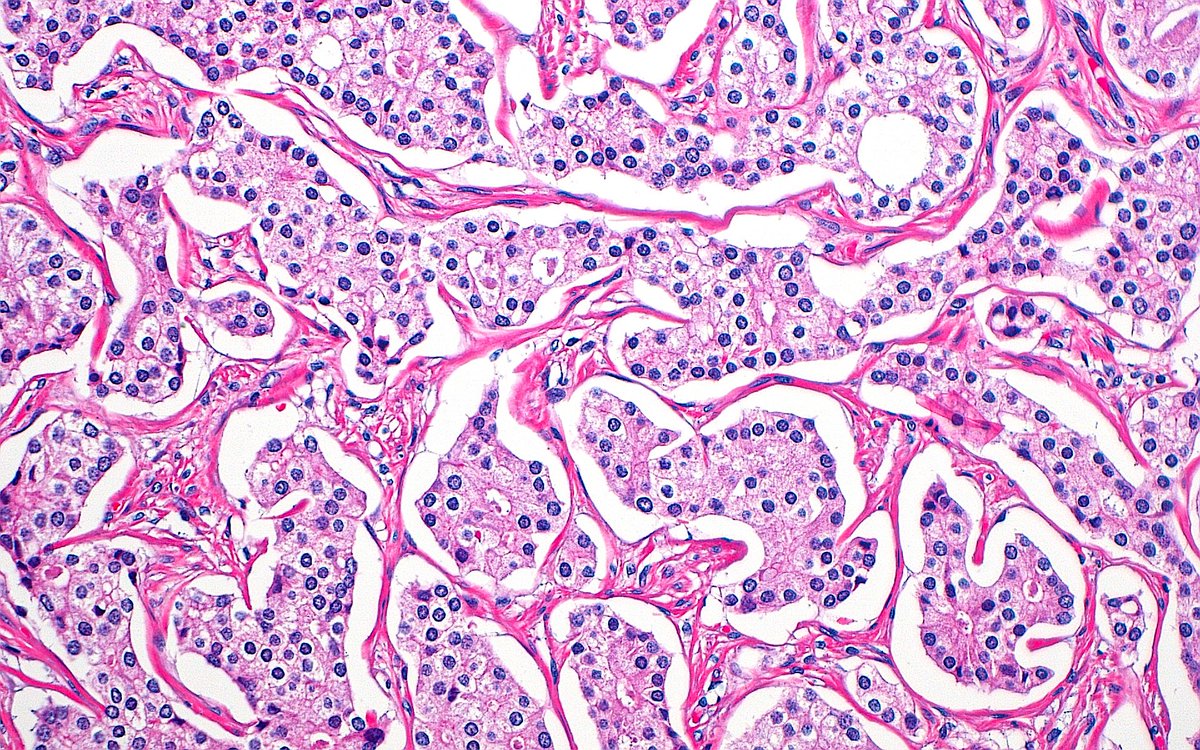 ziad_zaatari's tweet image. 🔬 Prostate Cancer "Puzzle" 🧩 ~ Prostatic adenocarcinoma glands with retraction artifact ~ #GUpath #Pathology #PathArt