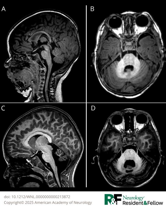 DrImranSheikh's tweet image. Cortical DWI Hyperintensity, Cerebellar Atrophy, and Presentation With Prolonged Postictal Hemiparesis Suggest CACNA1A-Related Disorder hubs.la/Q03y54550