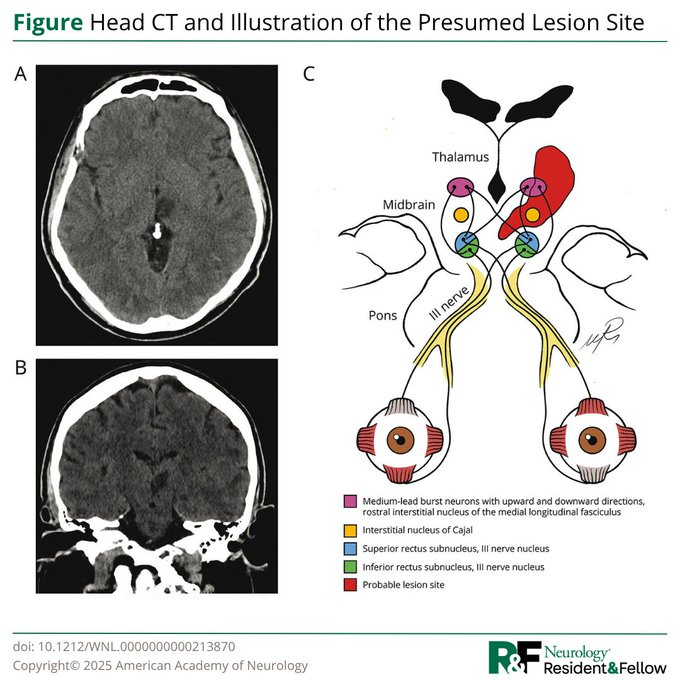 DrImranSheikh's tweet image. A 48yo man with multiple myeloma and chronic kidney failure presented with sudden-onset vertical diplopia and imbalance. Neurologic examination revealed a deficit of the right eye in upward gaze and of the left eye in downward gaze. See case: hubs.la/Q03xSlMN0