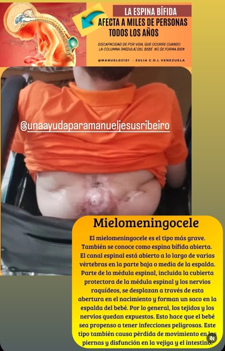 manuel02101's tweet image. La espina bífida afecta a miles de personas en el mundo todos los años. Hasta los momentos la ciencia no ha descubierto todo lo cierto que causa esta patología . Mi caso estuvo en investigaciones medicas por 5 años , hasta los momentos que nunca dijeron cual fue la causa.