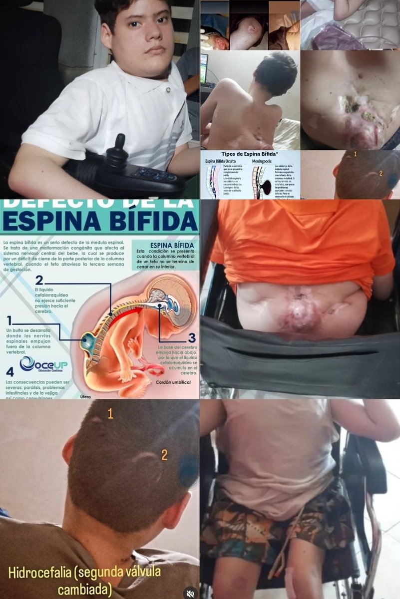 manuel02101's tweet image. La espina bífida normalmente viene asociada con otras patologías como mielomeningocele, vejiga neurogénica, hidrocefalia, algunas partes del cuerpo paralizado normalmente ocurren en los miembros inferiores.