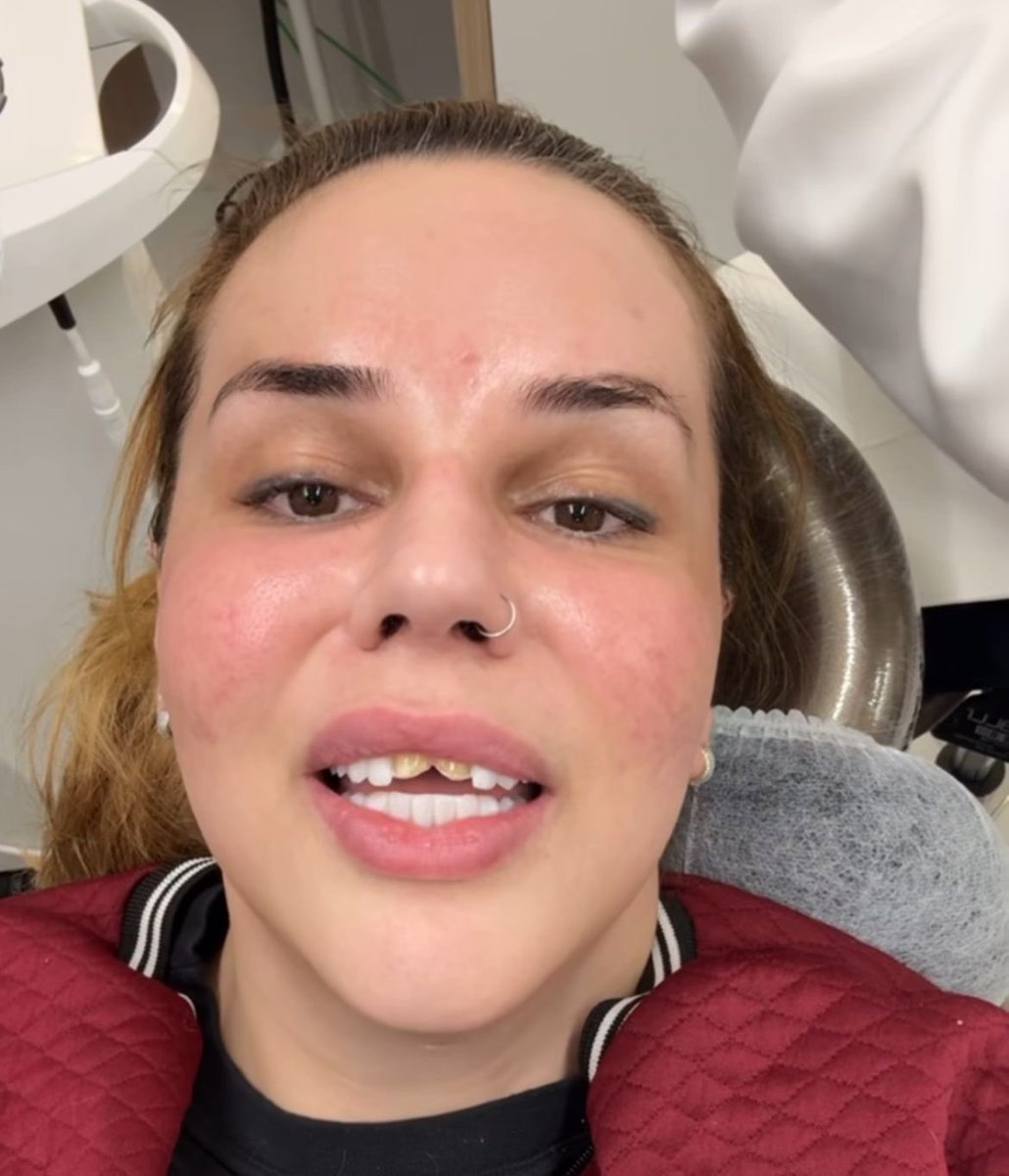 QGdoPOP's tweet image. Wanessa Wolf exibe o resultado do procedimento de aplicação de lente nos dentes.