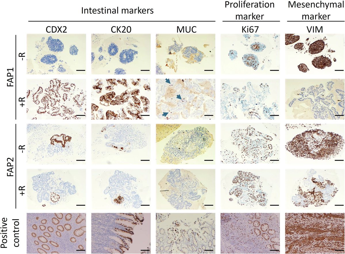 organoidscience's tweet image. In this new @cgtnature study, researchers found a link between APC mutation type, #organoid maturation, and FAP severity.
They show that rapamycin rescues APC-mutated colon organoid differentiation. 🧫
More here: go.nature.com/4muH3TZ