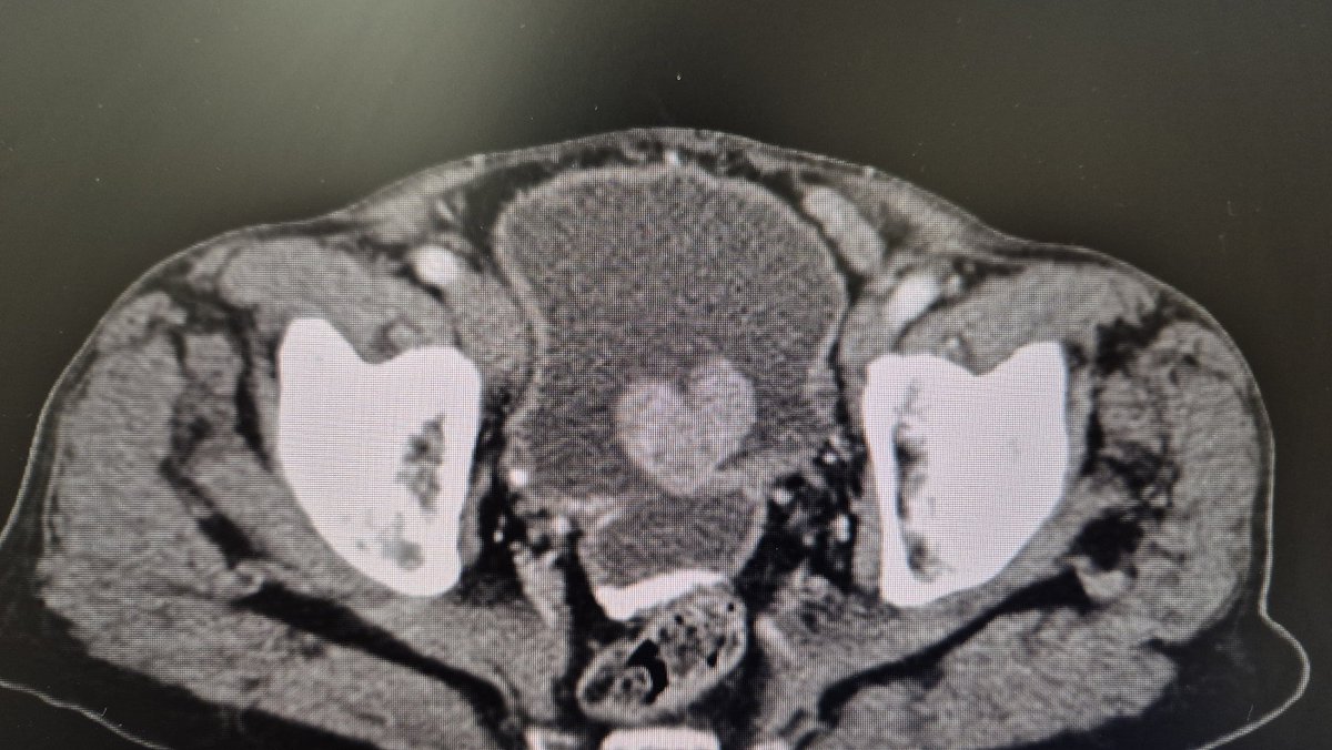 Sarvajit Biligere (@doc_sarvajit) on Twitter photo The way to a man's heart is through the bladder! 
#HoLEPverse
#UroSoMe
#HoLEP The way to a man's heart is through the bladder! 
#HoLEPverse
#UroSoMe
#HoLEP