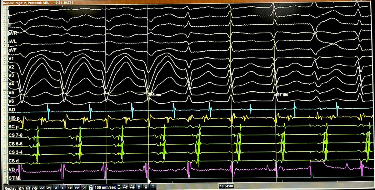 Thanks all for your inputs:

Answer:
“Reversed Coumel Sign”

Typical TCL prolongation in Coumel sign is the result of interaction btw
VA prolongation w/BBB &amp; AH shortening. 

Reversed Coumel Sign is the result of a huge AH prolongation after BBB resolution &amp; VA shortening.