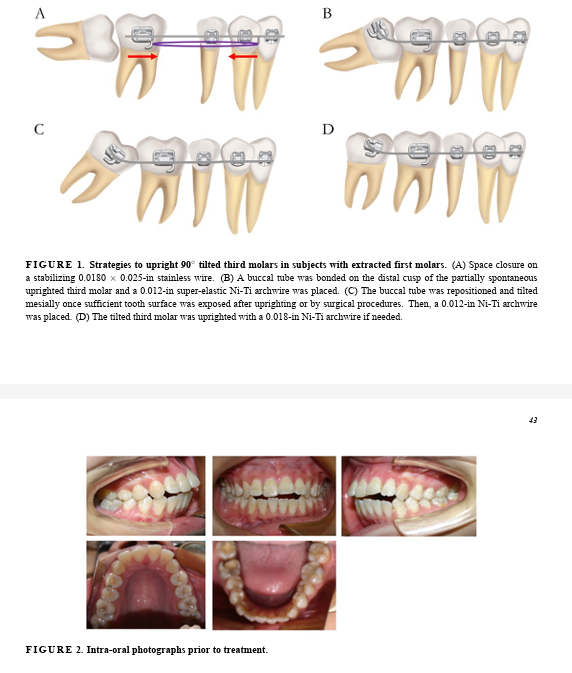 JOCPD_1974's tweet photo. New orthodontic technique uses superelastic Ni-Ti wires & tilted buccal tubes to upright 90ยฐ-tilted lower third molars after second molar protraction. Simple & effective! ๐ฆท๐ฌ #Orthodontics #ThirdMolar
Read more:https://t.co/tQQUGJkjRz https://t.co/vLJsrgUbJL