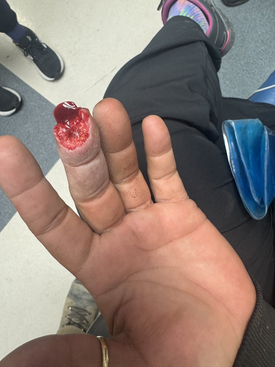 Here’s an updated pic of my pinched off fingertip and I added the original for context. It’s healing really well, but man the pins and needles feeling sucks. It’s crazy how the human body can heal.