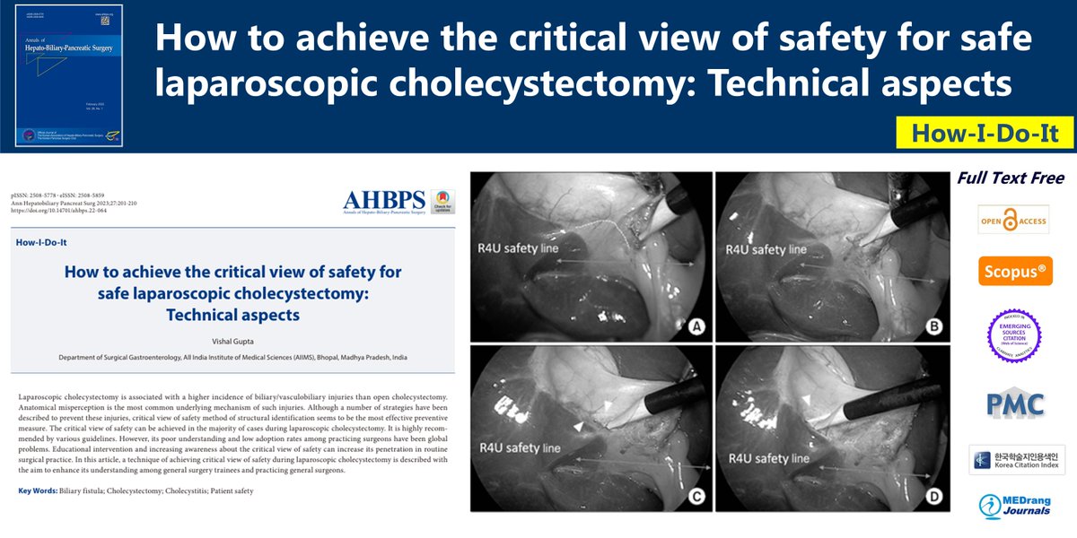 How to achieve the critical view of safety for safe laparoscopic cholecystectomy: Technical aspects
🌷doi.org/10.14701/ahbps…
Ann Hepatobiliary Pancreat Surg 2023 May;27(2) Vishal Gupta
#Biliary_fistula #Cholecystectomy #Cholecystitis #Patient_safety