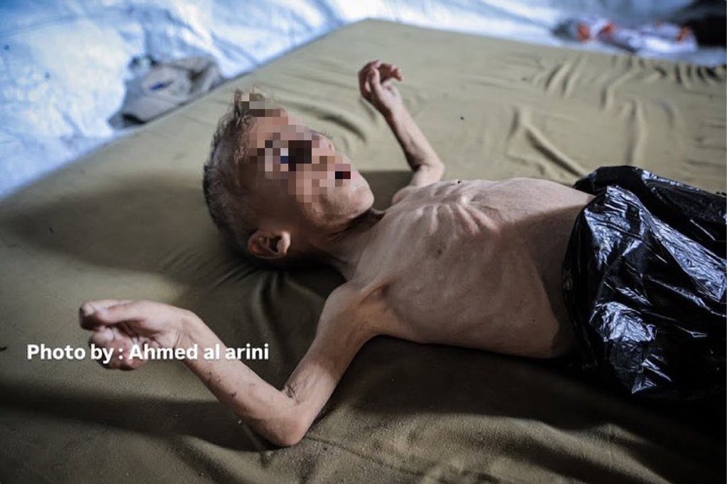 swilkinsonbc's tweet image. Gaza faces a horrific israeli-engineered famine: over 100 people have starved to death, including 90 children, says Dr Mohammed Zaqout