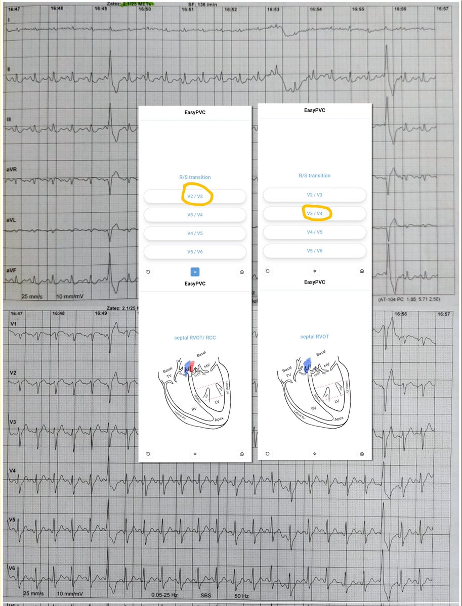 Milan Koštek (@kostekmilan) on Twitter photo Easy PVC app will provide two results depending on the precordial transition zone. This depends on the proper chest lead placement. It was different in the resting 12-lead ECG and during stress test (see the pic).
easy-ecg.com/EasyPVC
<a href="/melhamriti/">El Hamriti Mustapha</a> Easy PVC app will provide two results depending on the precordial transition zone. This depends on the proper chest lead placement. It was different in the resting 12-lead ECG and during stress test (see the pic).
easy-ecg.com/EasyPVC
<a href="/melhamriti/">El Hamriti Mustapha</a>
