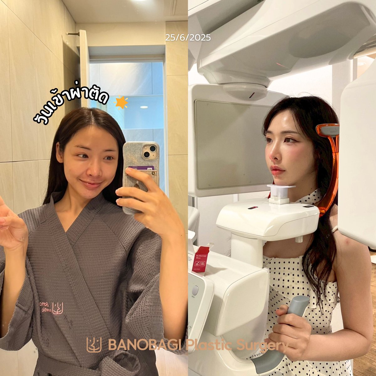 banobagithai's tweet image. ⭐️REAL REVIEW⭐️
คุณเจนนี่ หลังศัลยกรรมชุดใหญ่ 
✅ทำตา  
✅แก้จมูก  
✅Mini Vline

รีวิวหลังผ่าเพียง 20 วัน แต่บวมน้อยมากกกก
สวยเป๊ะปัง พร้อมออกเที่ยวได้เลย!

#ศัลยกรรมเกาหลี #โรงพยาบาลบาโนบากิ #บาโนบากิ #BanobagiPlasticSurgery #Banobagi #เกาหลี