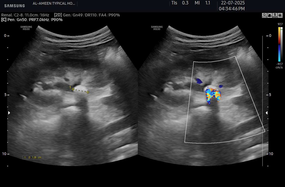 EchoTech_4's tweet image. When you Increase the PRF 📈
and Decrease the B mode Gain 📉

You will detect even small calcified stones by the Twinkle artifact.

#EchoTech #POCUS