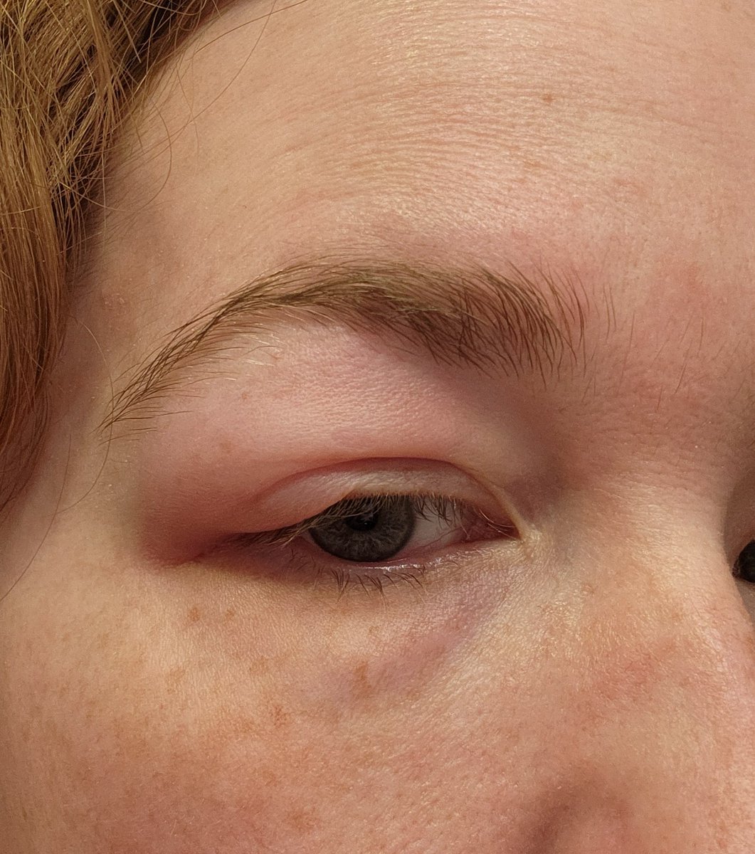 Got a mosquito bite on my eyebrow/eyelid and now im not having a good time since it grew in size in the last hr. 😭 i dont like the droop I can seeee itttt