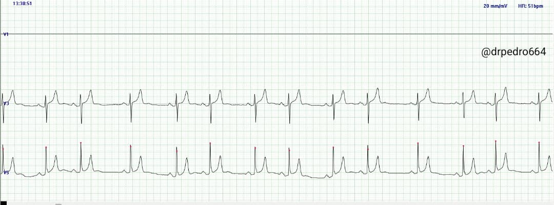 drpedro664's tweet photo. What's happening here? Female 81 yo, palpitations, 20 mm/mv https://t.co/sQW6KaM7J7