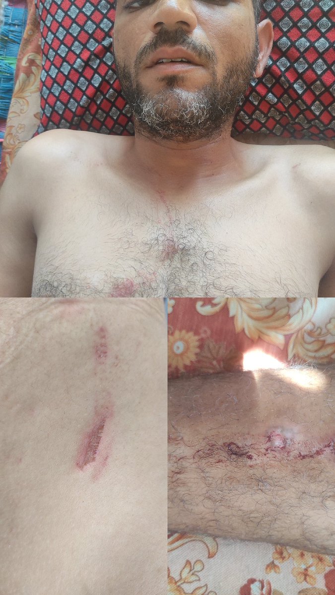 mohessa822942's tweet image. I have become unable to get food for my family. I have been injured in humanitarian aid and I need help. Please help chuffed.org/project/mohamm….