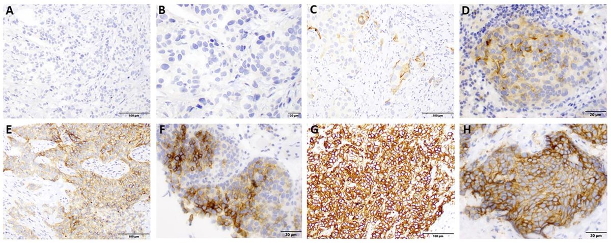 JPM_MDPI's tweet photo. 🚀 Selected Paper "Association of #CD47 Expression with #Clinicopathologic Characteristics and Survival Outcomes in Muscle Invasive #Bladder Cancer"

👨‍⚕️ Zin W. Myint et al., @universityofky 
🌵 Enjoy reading: https://t.co/a8K9MSnYhG

#mdpijpm #NeoadjuvantTherapy #Biomarker https://t.co/3Og1SjO1py