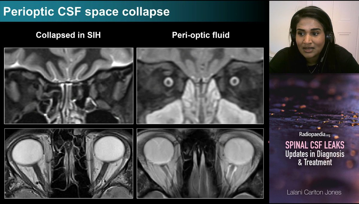 piandro3142's tweet image. Always a great talk from @NeuroradLal on SIH #Radiopaedia25!
Pearls:
- MRI brain: new to me is collapse of optic sheaths
- MRI spine: main role is SLEC (dural defect) vs no SLEC (CSF-venous fistula), fat-suppressed is best, go down to the sacrum, flow void sign can help localise
