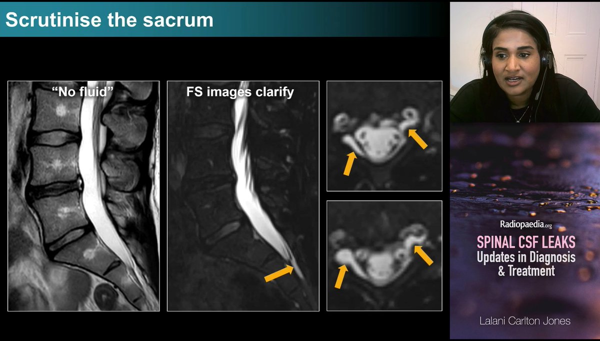 piandro3142's tweet image. Always a great talk from @NeuroradLal on SIH #Radiopaedia25!
Pearls:
- MRI brain: new to me is collapse of optic sheaths
- MRI spine: main role is SLEC (dural defect) vs no SLEC (CSF-venous fistula), fat-suppressed is best, go down to the sacrum, flow void sign can help localise