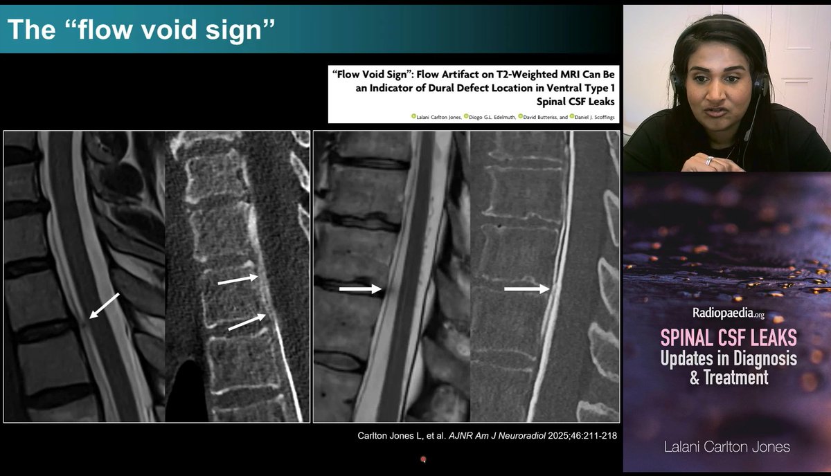 piandro3142's tweet image. Always a great talk from @NeuroradLal on SIH #Radiopaedia25!
Pearls:
- MRI brain: new to me is collapse of optic sheaths
- MRI spine: main role is SLEC (dural defect) vs no SLEC (CSF-venous fistula), fat-suppressed is best, go down to the sacrum, flow void sign can help localise