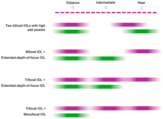 JCM_MDPI's tweet image. #mdpijcm
Enjoy new #Feature_Paper
Review of Mix-and-Match Approach and Binocular ##Intraocular_Lens Systems
🎯mdpi.com/3359202
by Tadas Naujokaitis et al. 
Views 480 @MediPharma_MDPI